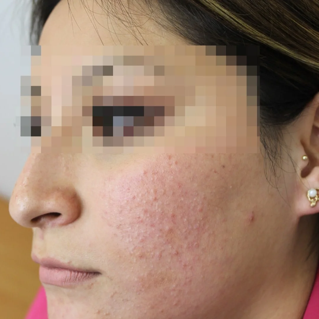 Antes tratamiento acné