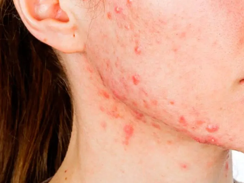 Tratamiento de acné en Puebla