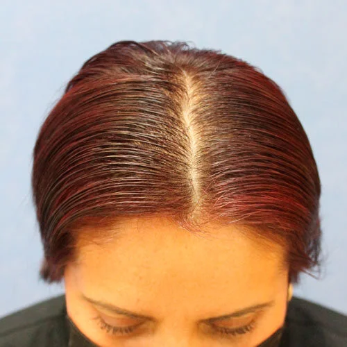 Después alopecia mujer