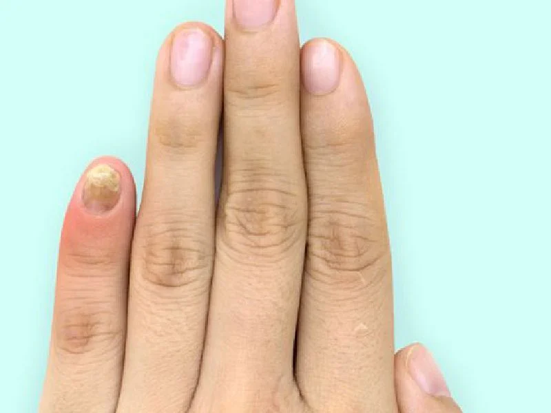 Enfermedades de uñas Puebla