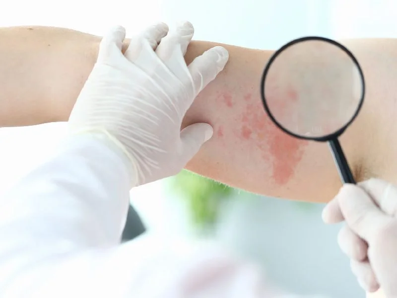 Hongos en piel y uñas Puebla